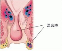 混合痔的病因有哪些?