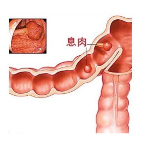 结肠息肉的原因