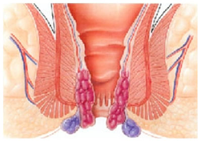 内痔病理图