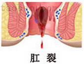 拉屎拉出好多血是怎么回事?该怎么办?