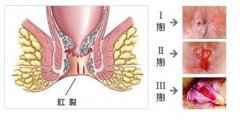 肛裂原因有哪些?