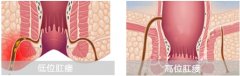 肛瘘治疗多少钱?