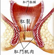 肛裂百科