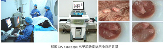 肛肠镜检查
