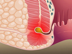 肛瘘病因