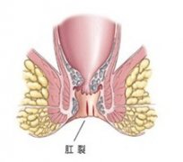 肛裂zxylw.com的表现你了解吗?