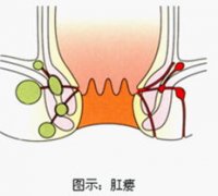 肛瘘gcgt出血的原因有哪些?