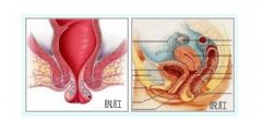 什么是脱肛和痔疮gcgt的区别?