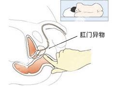 肛门异物原因