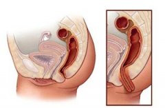 女性脱肛的三个时期的症状