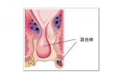 武汉混合痔piles患者需要注意什么呢?