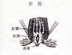 武汉肛裂pilesask病变的四个阶段