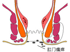 肛门瘙痒原因