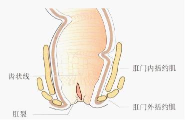肛裂症状