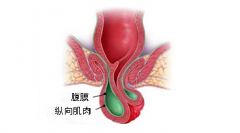 脱肛的症状是什么?