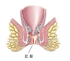 肛裂并发症