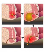 肛瘘pilesask有哪些阶段？