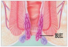 脱肛是什么原因引起的?