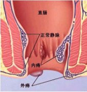 痔疮zxylw.com患者需要注意什么?