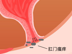 肛门瘙痒预防