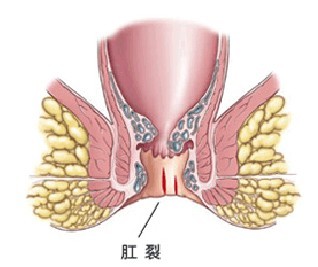 肛裂病因