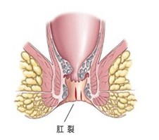 肛裂病理图
