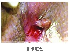 二期肛裂