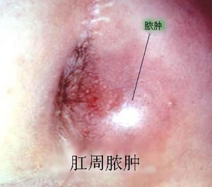肛周脓肿病因