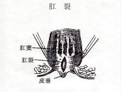肛裂四阶段