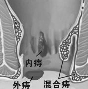 痔疮piles 可以分为哪几种?