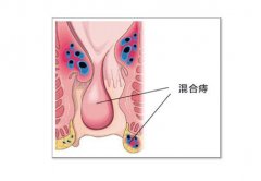 武汉混合痔piles久拖不治有什么危害?