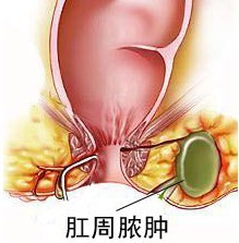 肛周脓肿症状