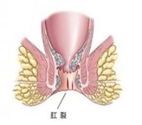 怎么知道自己是不是患了肛裂?