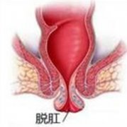 脱肛原因有哪些?