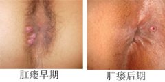 肛瘘pilesask的症状表现是什么?