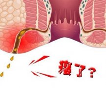 引起肛瘘zxylw.com的几大原因是哪些?